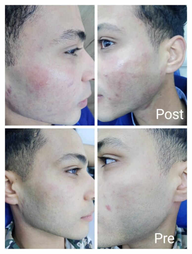 Improve large pores on the face after only two sessions
